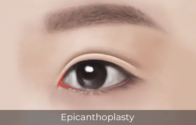 Canthoplasty