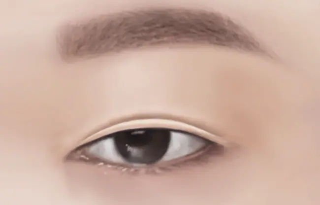 Eyes Ptosis Correction Non Incisional