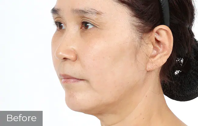 Anti Aging Mid Face