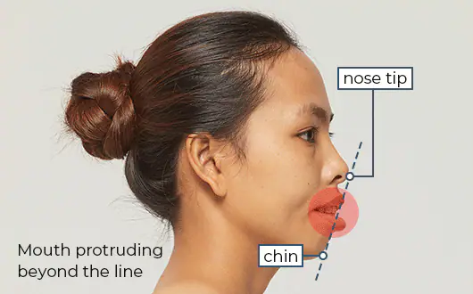 Face Protruding Mouth Correction