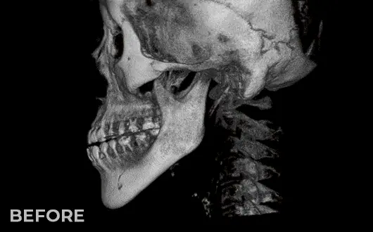 Two Jaw Surgery