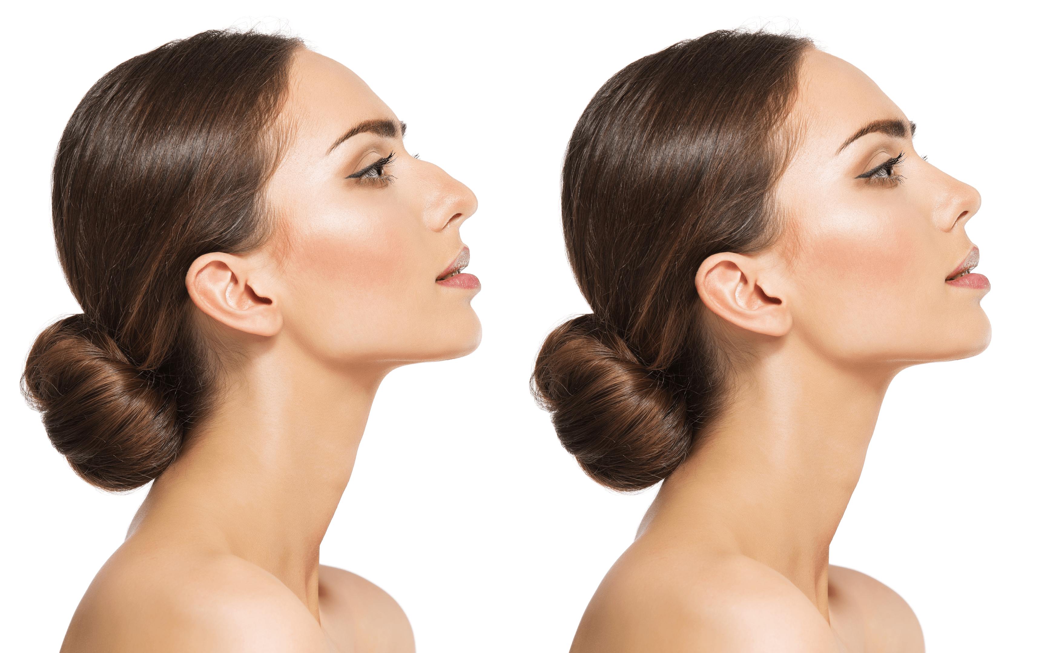 What is Augmentation Rhinoplasty? | Banobagi Korean Nose Surgery