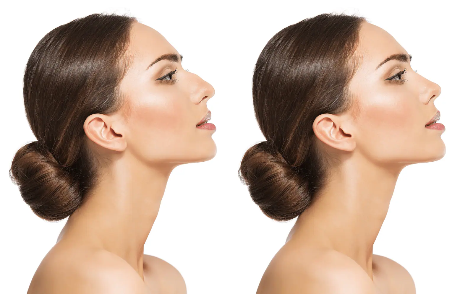What is Augmentation Rhinoplasty? | Banobagi Korean Nose Surgery — Download