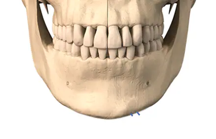 Chin & Genioplasty — Sec Method
