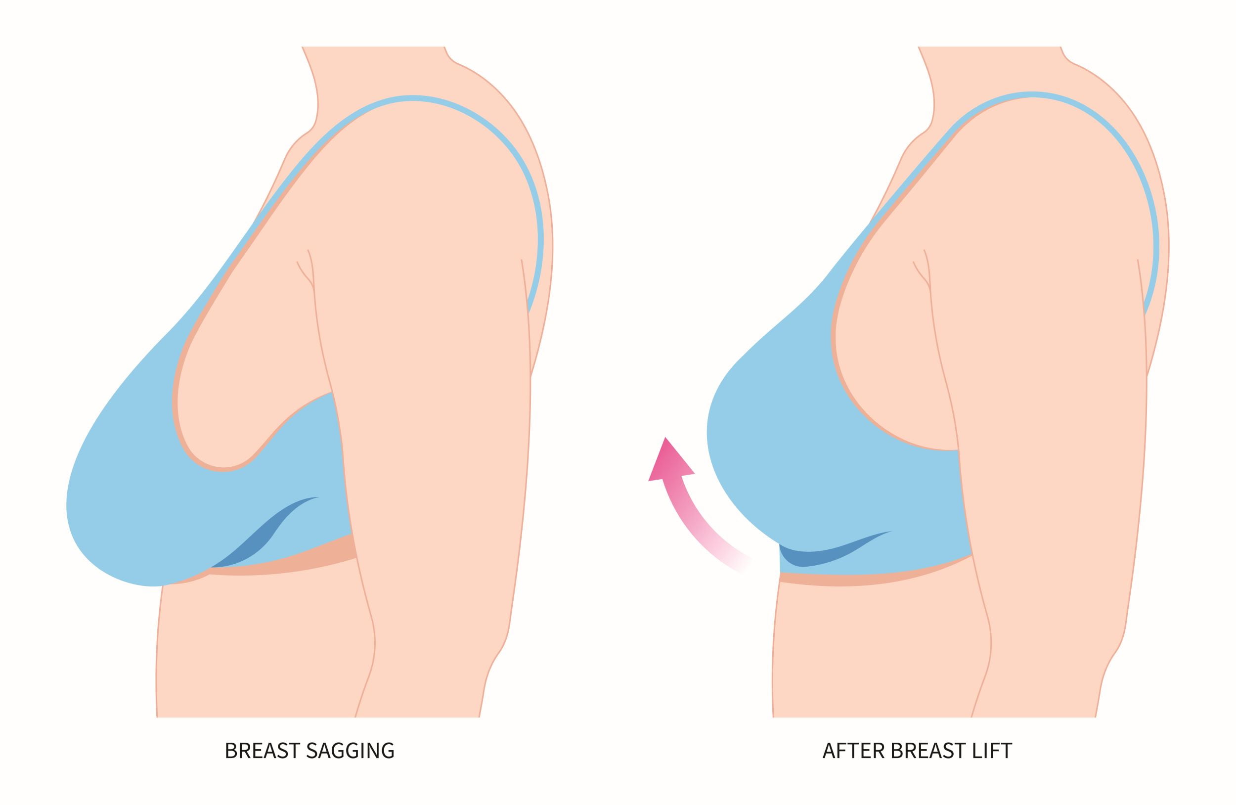 Say Goodbye to Sagging: Breast Lift/Ptosis