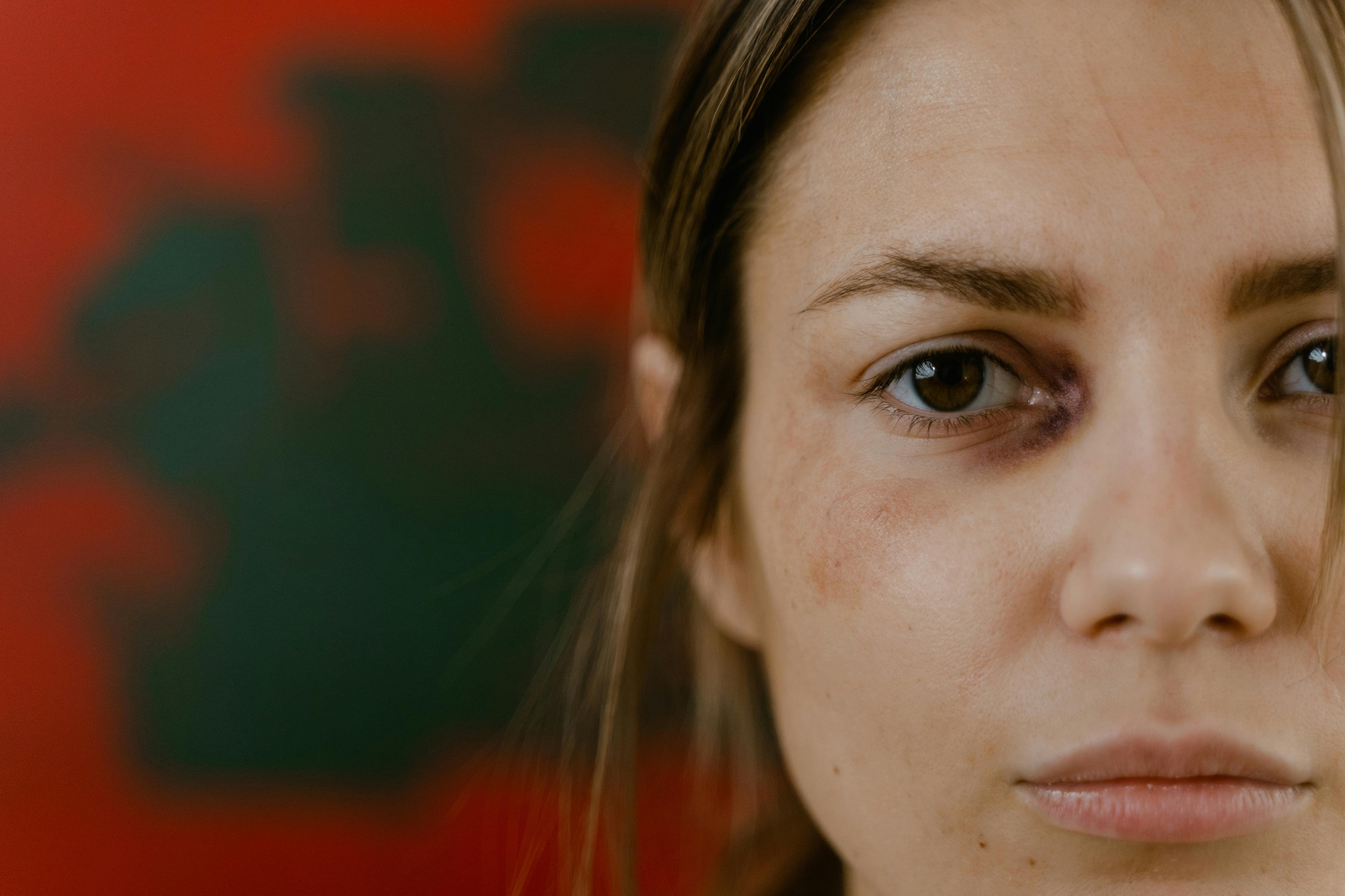 Treating Bruising After Surgery