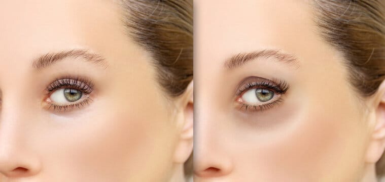 Rejuvenating Eyes with Under Eye Fat Transfer