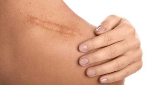Treating and Preventing Scar Tissue After Surgery: A Guide to Seamless Results