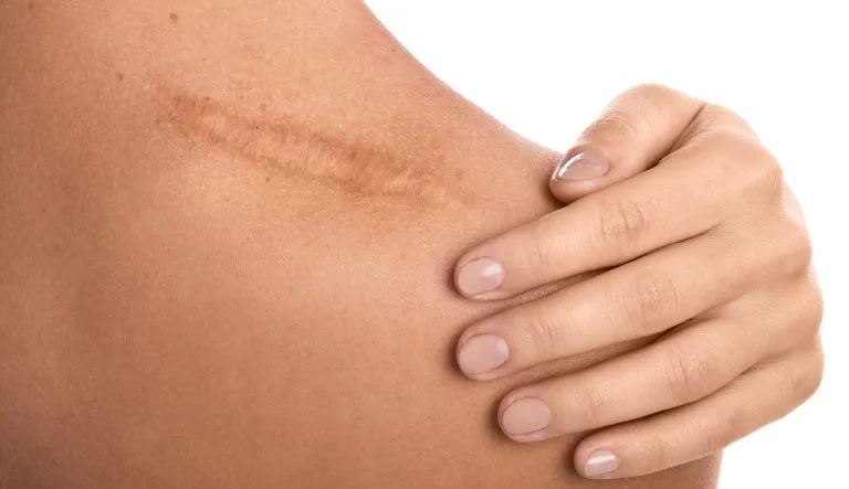 Treating and Preventing Scar Tissue After Surgery: A Guide to Seamless Results