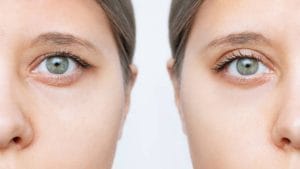 Safety First: Revising Botched Upper Eyelid Surgery at Banobagi