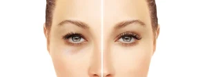 Blepharoplasty Before and After: A Detailed Guide to the Healing Stages