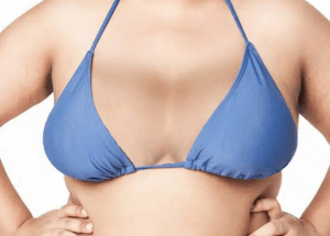 Identifying and Treating Symmastia: Restoring Natural Separation