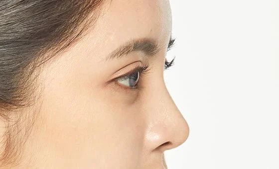 Augmentation rhinoplasty after