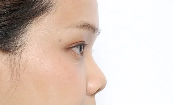 Augmentation rhinoplasty before