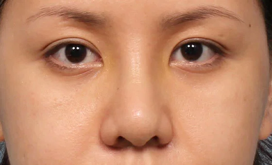 Alarplasty after