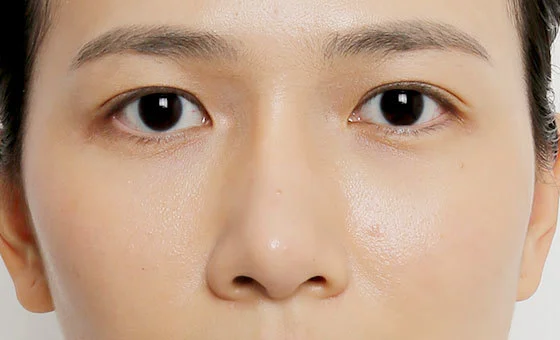 Nose revision before