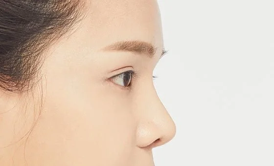 Augmentation rhinoplasty after