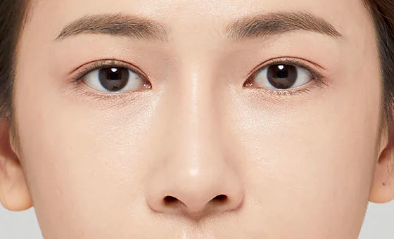 Nose revision after