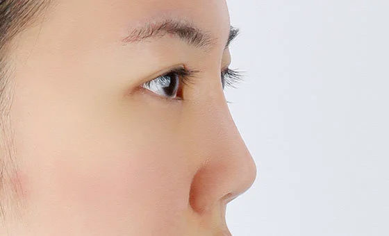 Nose revision before