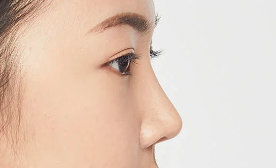Nose revision after