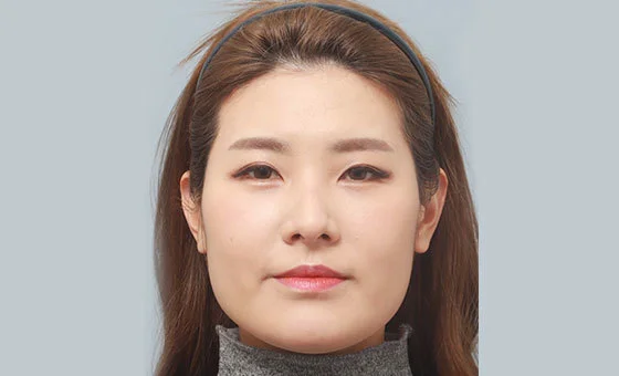 Cheekbone reduction before