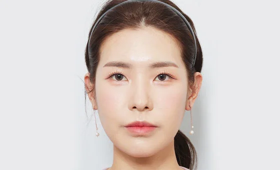 Cheekbone reduction after
