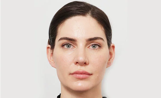 Cheekbone reduction before
