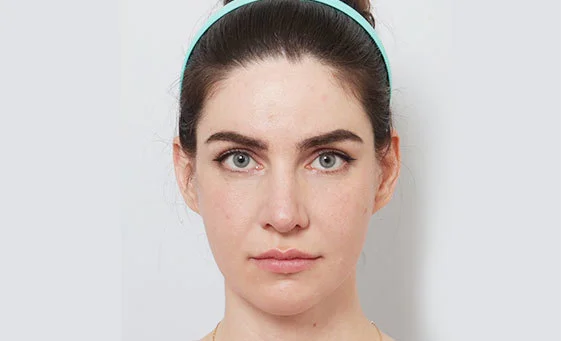 Cheekbone reduction after