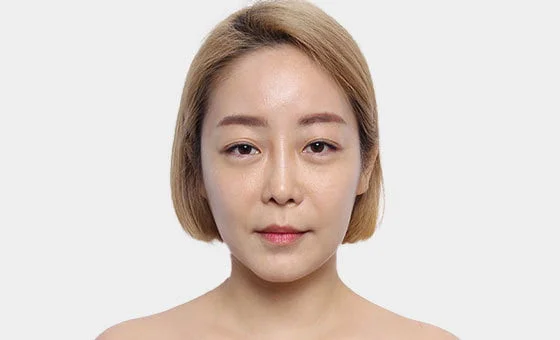 Chin genioplasty before