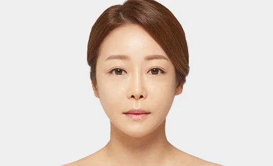 Chin genioplasty after
