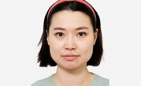 Chin genioplasty before