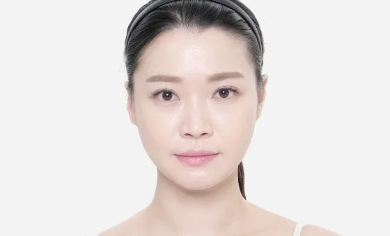 Chin genioplasty after