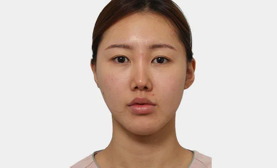 Face contour revision before