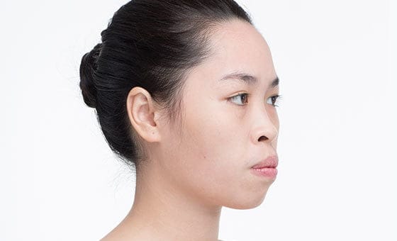 Protruding mouth correction before
