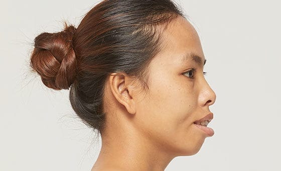 Protruding mouth correction before