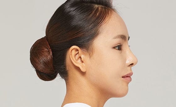 Protruding mouth correction after