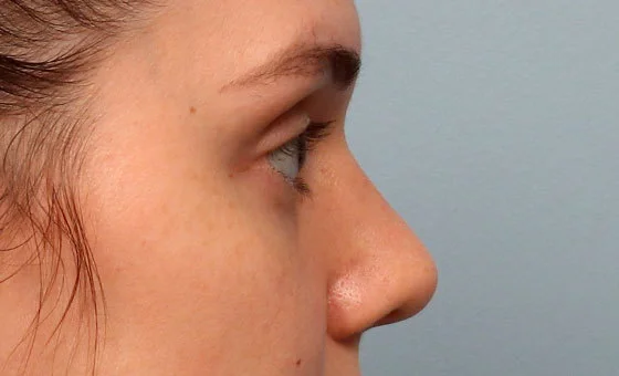 Hump reduction after