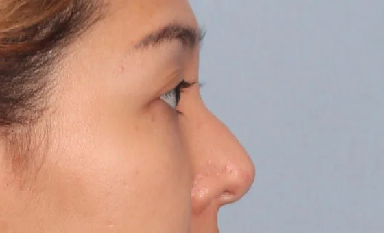 Hump reduction before