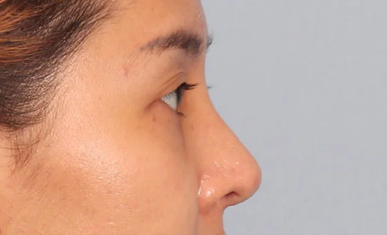 Hump reduction after