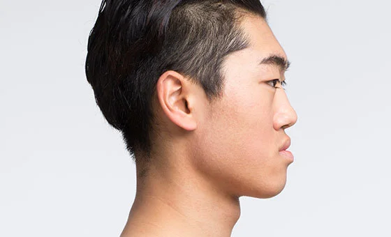 Two-jaw surgery before