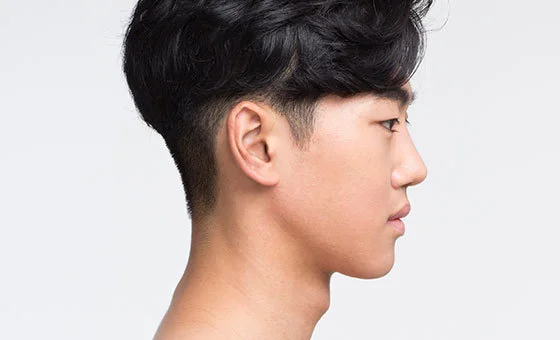 Two-jaw surgery after
