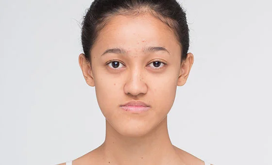 Two-jaw surgery before