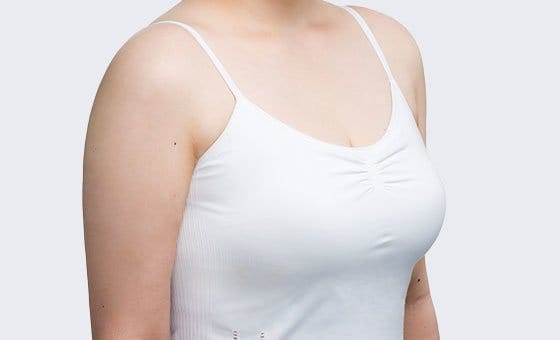 Reduction — After