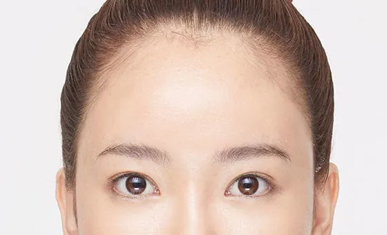 Brow and forehead lift after