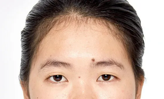 Brow and forehead lift before