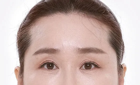 Brow and forehead lift after