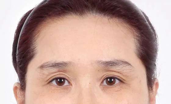 Brow and forehead lift before