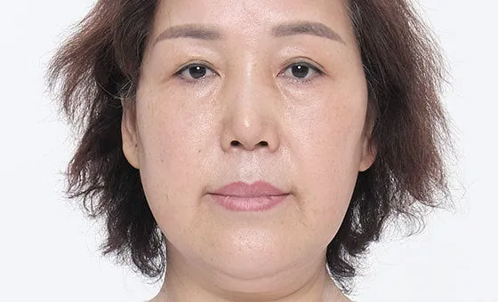 Lower face lift before