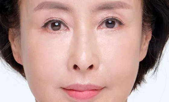 Mid-face lift after