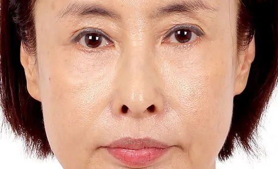 Mid-face lift before